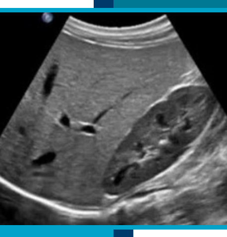 Abdominal and Renal Ultrasounds in Navasota and Tomball, TX