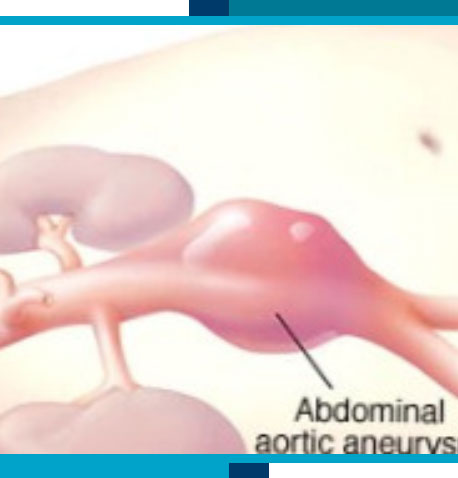 Aortic Aneurysm Ultrasounds in Navasota and Tomball