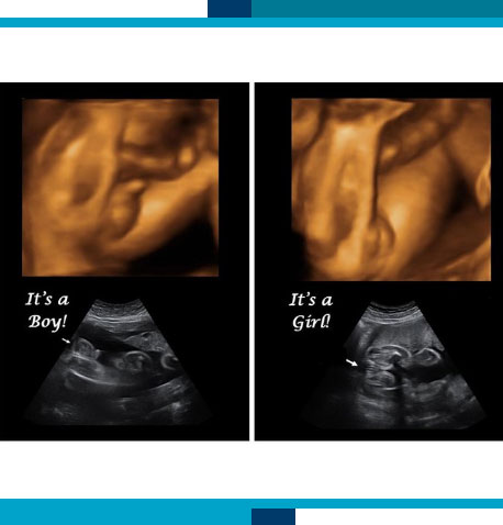 Gender Determination Ultrasounds in Navasota, TX