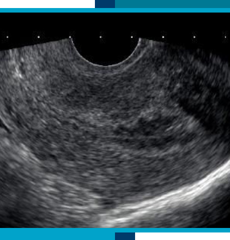 Gynecological and Pelvic Ultrasounds in Navasota and Tomball, TX