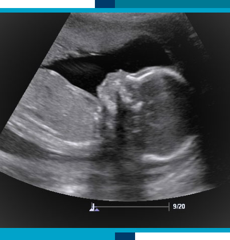 Obstetrical Ultrasounds in Navasota and Tomball, TX