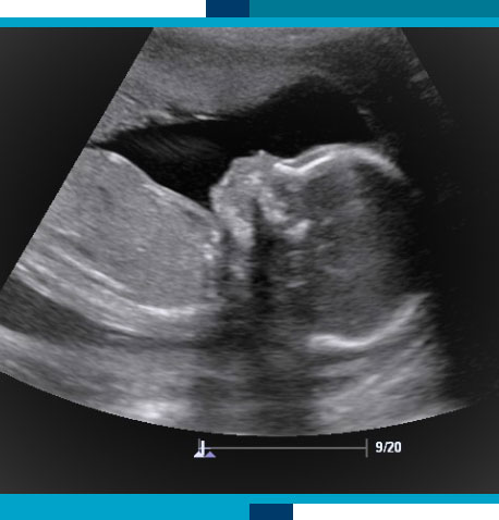 Obstetrical Ultrasounds