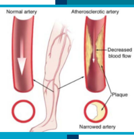 Peripheral Arterial Disease Screening in Tomball and Navasota
