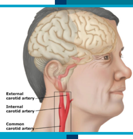 Stroke Screening Ultrasounds in Navasota and Tomball